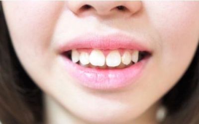 Răng hô là gì? Giải pháp xử lý hàm răng hô cho nụ cười hoàn hảo