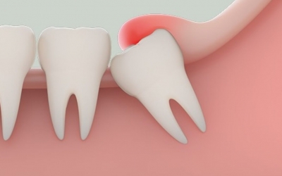6 cách giảm đau sau nhổ răng khôn